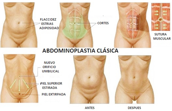 Cicatriz Abdominoplastia: cuidados-evolución días-meses-año.